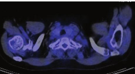 F-18 FDG PET/CT 검사방법모든환자는영상촬영전최소한 6시간이상의금식과충분한수분섭취 (1 L 정도 ) 를하고적정혈당 (180 mg/dl 이하 ) 이확인된후에검사를시행하였다. PET/CT (Biograph16 Hi-Res; Siemens, Erlangen, Germany) 를이용해두개골기저부에서 B D A C E Figure 1.