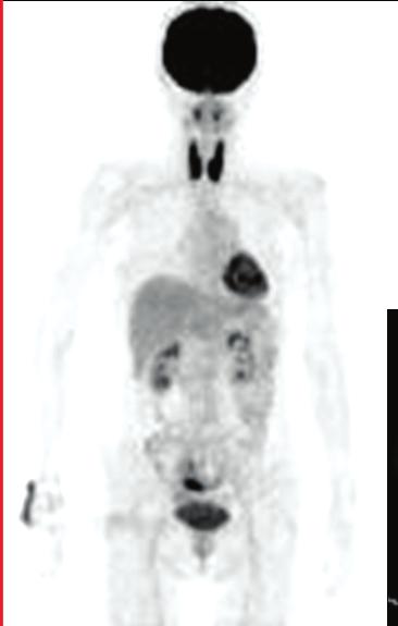 A case of diffusely increased F-18 FDG uptake, similar intensity