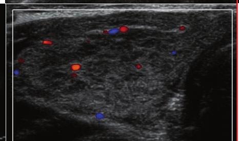 22 ng/dl, suggestive of normal state of thyroid function.