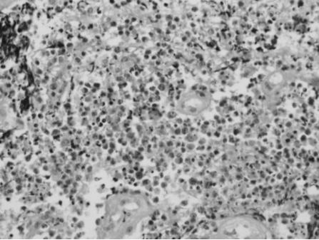 대한내분비학회지 : 제 23 권제 4 호 2008 A B Fig. 2. Microscopic section from a tumor specimen. A. The tumor cells were pleomorphic with large nuclei and a coarse chromatin pattern.