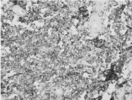 Tumor cells expressed the CD20 and showed dark membrane staining. (CD20 immunohistochemical stain, 400) Table 1.