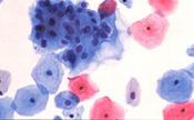 HPV 감염증 Human papillomavirus 병변부위조직및도찰물 - 자궁경부 - 성기부위 유전자검사 - Hybridization assay 유전형검사 - PCR - DNA microarray 조직학적검사 - 세포진검사 + - + - + -