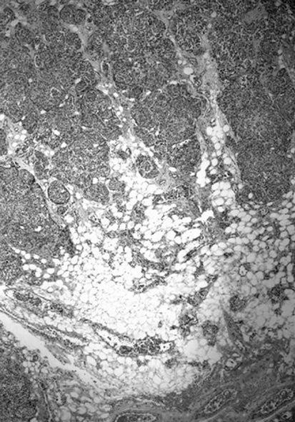 402 강민수 문규필 김경택외 3 인 Figure 4. (A) The meningotheliomatous tumor cells were arranged in nests reminiscent of paraganglioma with hyalinized stromal vasculature.