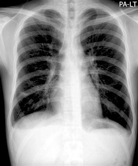 Tuberculosis and Respiratory Diseases Vol. 66. No. 5, May 2009 부비동염을진단후천식조절흡입제및속효성기관지확장제로증상조절중호전과악화가반복되었다.