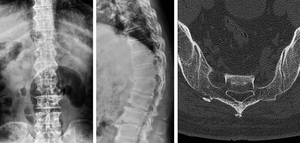 Jaedong kim et al Volume 24 Number 2 June 2017 A B C Fig. 1. Preoperative radiographs. (A) Anteroposterior view of a thoracolumbar spine radiograph shows osteophytes connecting the thoracic vertebrae.