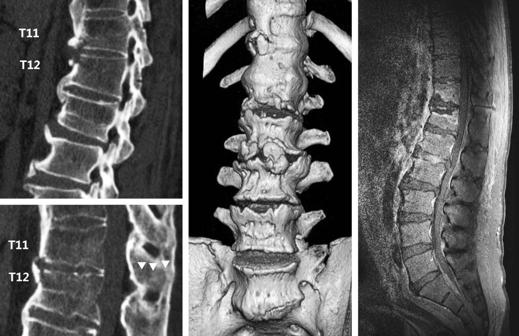 Journal of Korean Society of Spine Surgery Kyphotic Deformity After Spinal Fusion in DISH A B C D Fig. 2. Preoperative CT and MRI.