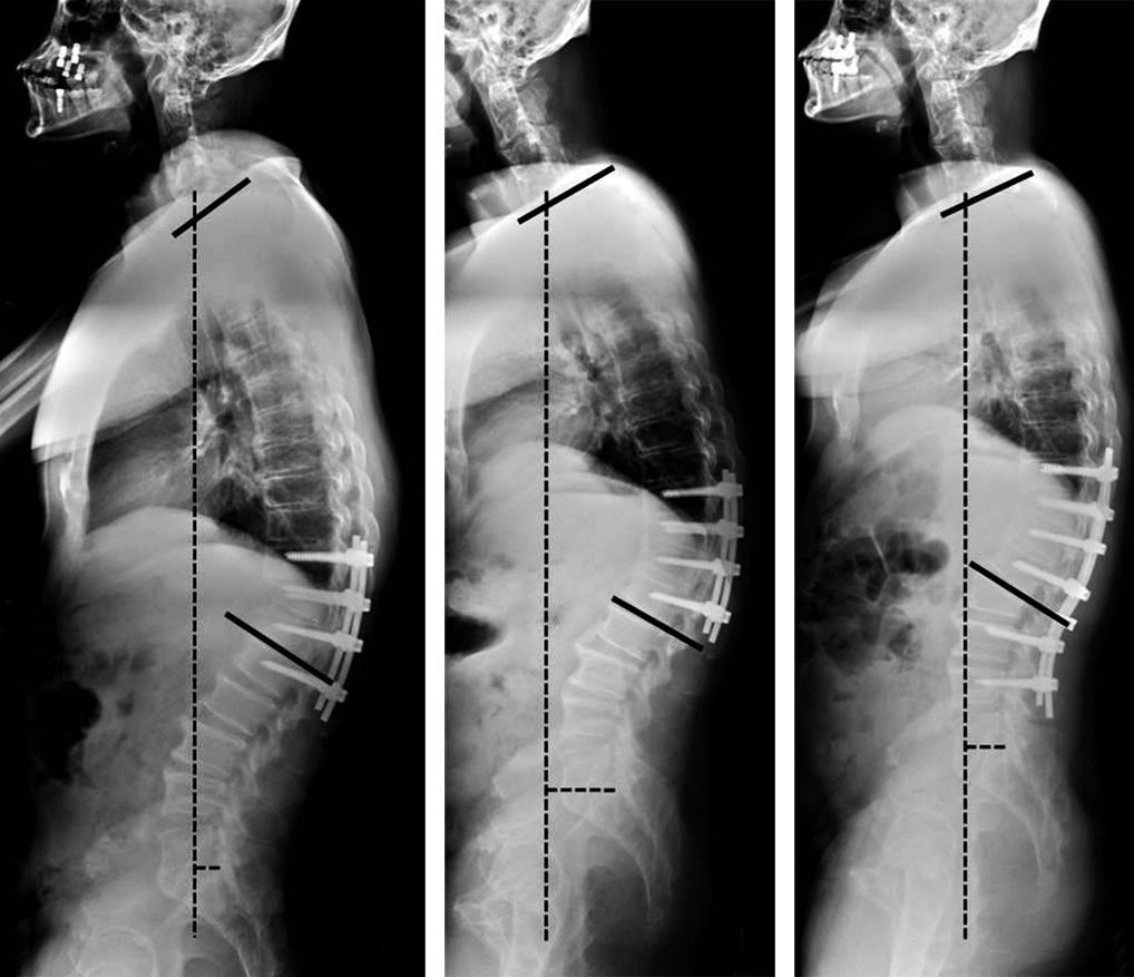 (C) Three-dimensional CT shows the fracture of the vertebral body of T11 and T12.