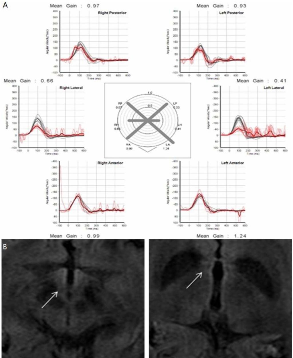 장혁수 외 3인. 수평전정안구반사 소실이 주증상인 베르니케뇌병증 4예 Fig. 4. The patient s findings (Case 4) of video head impulse test and brain magnetic resonance imaging (MRI).