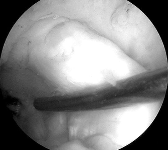 Figure 3. Arthroscopic classification of grafts based on synovialization. (A) Good synovialization of the grafted tendon.