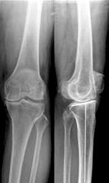 (A) A 64-year-old woman have the open wedge high tibial osteotomy under navigation control.