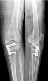 (B) In the navigation system, the post-osteotomy MA is valgus 3.5 o and the MA% is 57.7%.