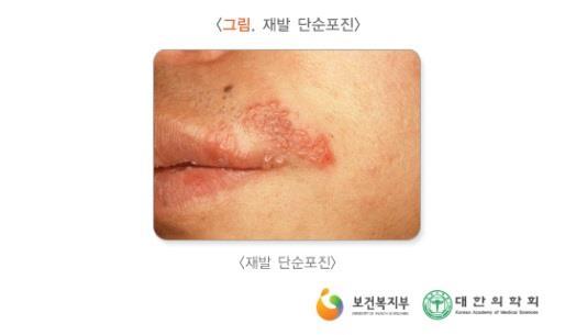 Special Issue 단순포진 (Herpes simplex) 1. 개요단순포진 (herpes simplex) 이란헤르페스바이러스 (human herpes viruses) 에속하는단순포진바이러스가피부와점막에감염을일으키는질환으로주로수포 ( 물집 ) 가발생하는병임.