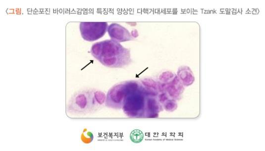 단순포진 1형바이러스감염은감기에걸리거나몸이피곤한경우입가에물집이생기는경우로흔하게발견할수있고단순포진 2형바이러스감염은주로성기부위에발생하는음부포진을특징으로나타남. 음부포진은성기부위에수포가재발하여일상생활에지장을줄뿐만아니라임산부에게서태아에게전파되어태아에게치명적인영향을끼칠수있는등여러가지문제들을동반할수있음 2.