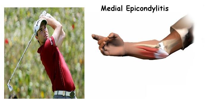 Golfer s elbow 원인 : 골프의스윙, 투수의피칭, 손으로물건들어올리기와잡기, 망치및드라이버작업등과같은손목관절굽힘동작이반복될때 elbow joint 의 medial epicondyle 에서 origin 하는 pronator teres flexor carpi radiallis flexor