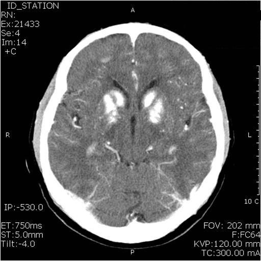 Brain CT shows extensive calcifications in the basal ganglia, thalami, cerebellar deep nuclei, and cerebral white matter. 2) 내분비검사혈청활성형부갑상선호르몬은 3 pg/ml ( 정상치 : 12~65 pg/ml) 이었고, 혈청이온화칼슘치는 0.