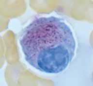 Note the lack of staining in surrounding cytoplasm (acid phosphatase, 1,000). (C) Negative in non-specific esterase stain (Non-specific esterase, 1,000).