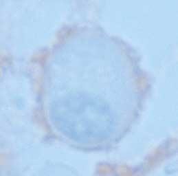 봉입체들은 acid phosphatase 염색에강양성을나타내었으며 (Fig. 1), -naphthyl acetate esterase 음성이었고 (Fig. 1C), 면역염색결과 Ig-kappa형임을알수있었다 (Fig. 1D, E). 신장생검결과역시 kappa형경쇄에의한벤스- 존스신증이확인되었으며, Congo red 음성이었다 (Fig. 2).