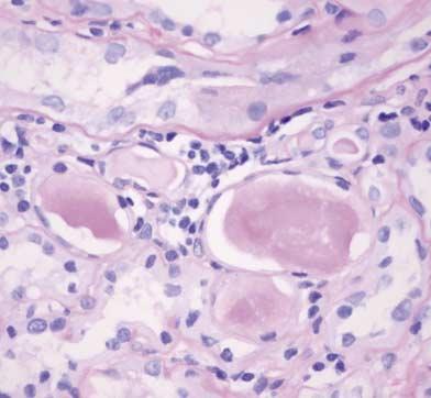 250 강지민 김진아 신석준외 1 인 C D Fig. 2. The kidney biopsy revealed ence Jones cast nephropathy with kappa light chain positivity. () H-E stain, 100.