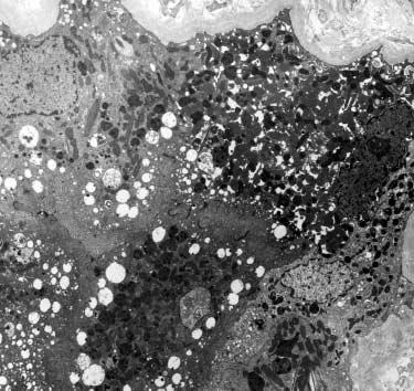 uer rod 양봉입체를보이는판코니증후군동반 Ig kappa 경쇄침착질환 251 Fig. 3. Ultrastructure of tubular epithelial cells in a case of Ig myeloma kidney.