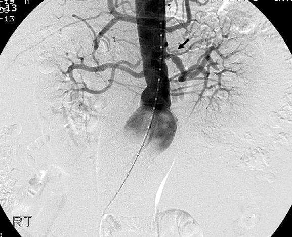 침범하고 있는 최대 직경 6.5 cm 크기의 복부 대동맥류가 발견되었다(Fig. 2). 복부 대동맥류는 EUROSTAR의 분류로 B형에 해당되 Fig. 2. Abdominal aortic aneurysm.