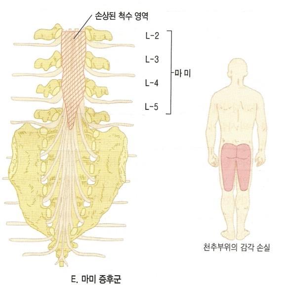 마미증후군 척수원추이하요부천골신경근손상 방광, 장, 하지반사상실