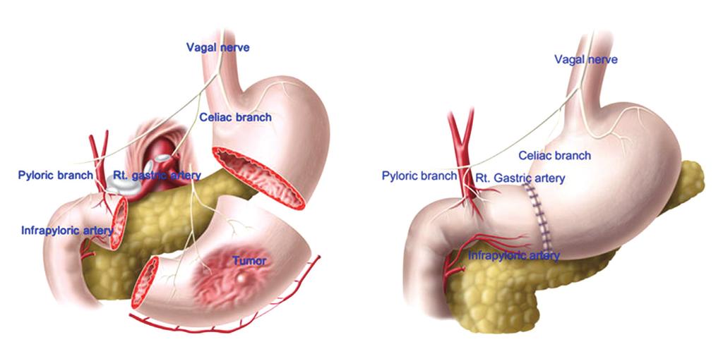 Resin을음식에섞어환자가섭취한뒤시간당배출정도를알아보는위배출검사 (Gastric emptying study)