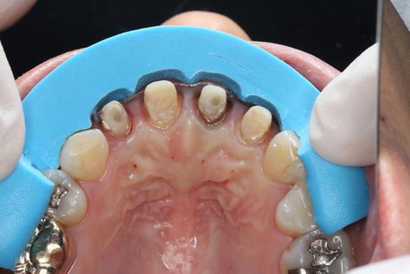 신세준 노관태 권긍록 김형섭 Fig. 11. Clinical try-in using interim restoration by conventional manner. 전치부의 심미 수복을 위하여 Digital Smile Design을 적용한 증례 Fig. 12. Tooth preparation and impression taking.