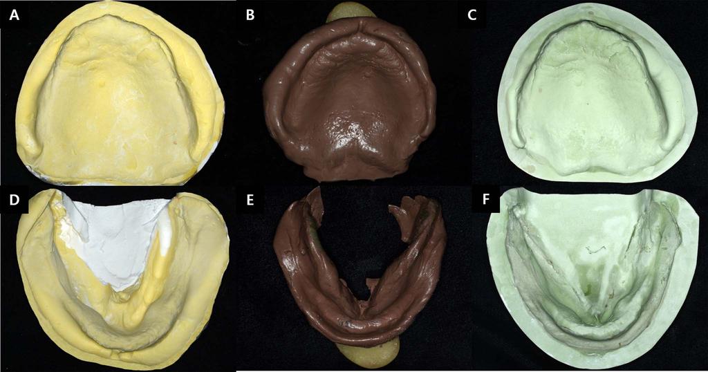 Neutral zone concept for denture stability Fig. 4. Diagnostic model (A, D), final impression (B, E) and master cast (C, F). Fig. 5.