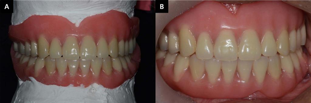 occlusal view of lower impression (D), lower labial impression (E), and lower lingual impression (F). Fig. 8.