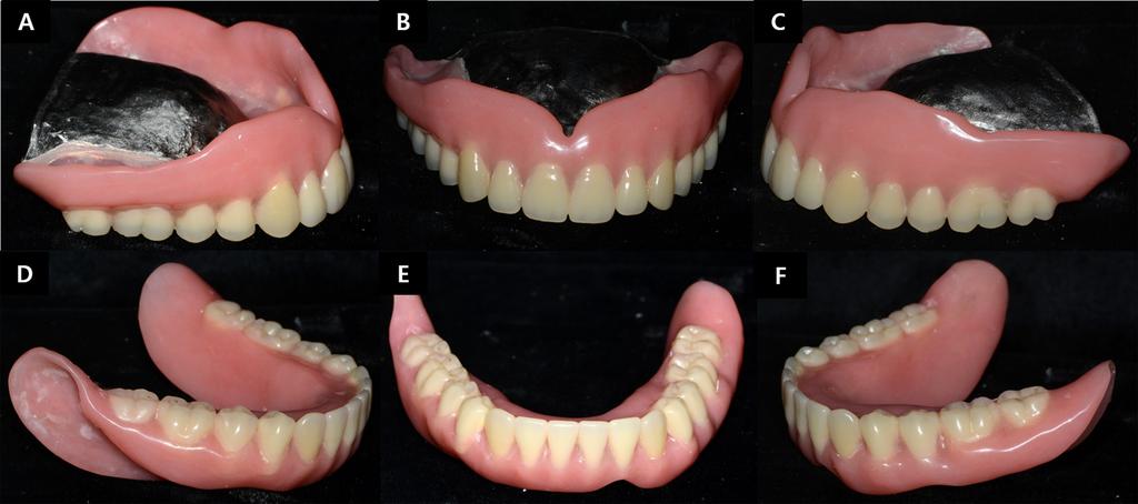 Upper complete denture (A, B, and C) and lower complete denture (D, E, and F).