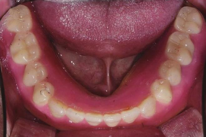 치아배열이완료된납의치는환자내원시시적하여안모평가및수직고경, 교합등을확인하였고, 연마면형성위해 external impression 시행하였다 (Fig. 8).
