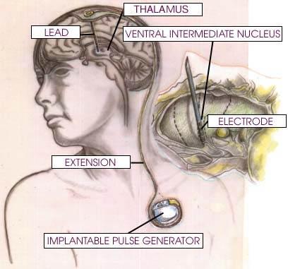 Deep-brain Stimulator n The multi-electrode lead is placed in the