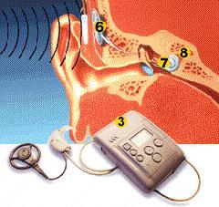 Cochlear Implants Microphone Speech
