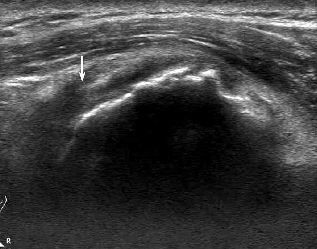 (D) Postoperative 6 months follow up USG of tendon to tendon repair revealed remained gap. Arrow in figure A, B, C: stump of rotator cuff tear. Arrow in figure D: remained gap. 이었다.