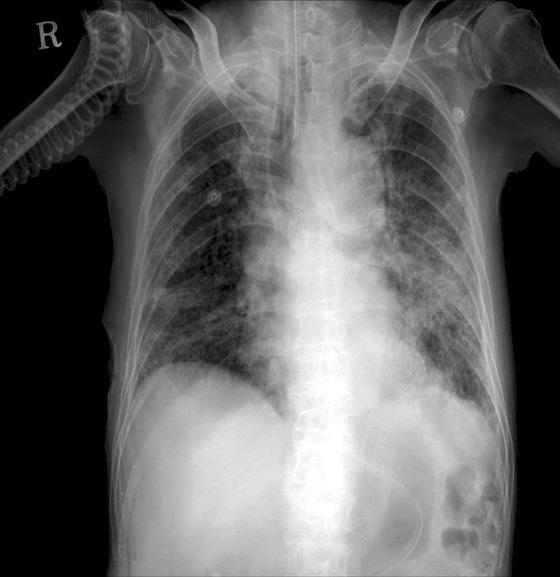 JH Lee et al: Pulmonary infection due to A. xylosoxidans Figure 1.