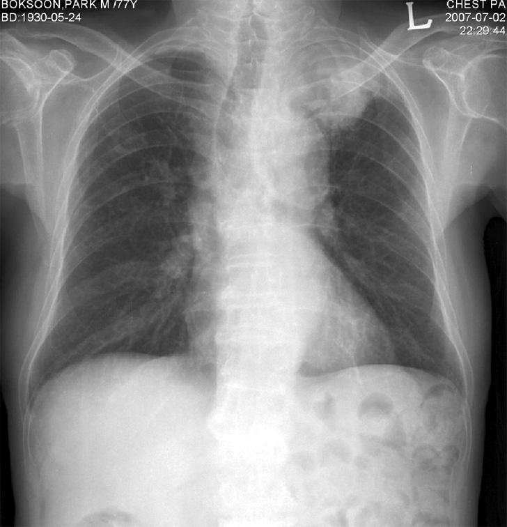 Following chest x-ray (HOD#14), the lung abscess on the apical area of left upper lobe has decreased but pneumonic consolidation has developed at left lower lobe (B). 장절제술등의병력은없었다.