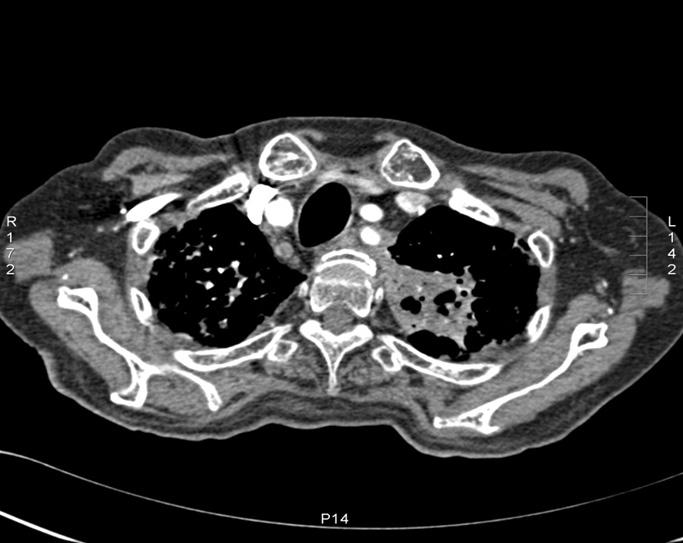 Tuberculosis and Respiratory Diseases Vol. 64. No. 1, Jan. 2008 Figure 2. Case 1: Initial chest CT shows necrotic mass and cavity in the left upper lobe (A).