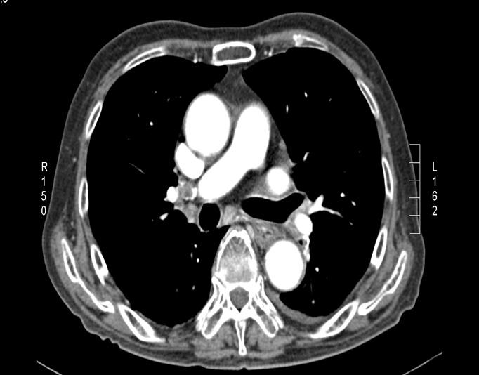 Following chest CT (HOD#20) shows that the size of lung abscess has decreased at the left upper lobe (C). 주소 : 좌측흉부통증, 호흡곤란현병력 : 10일간의좌측흉부통증있었으며내원당일호흡곤란증상있어내원하였다. 과거력 : 40년전폐결핵을완치받았다.