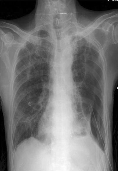 JH Lee et al: Pulmonary infection due to A. xylosoxidans Figure 3. Case 2: Initial chest X-ray shows that large amount of loculated hydropneumothorax at the left thorax (A).