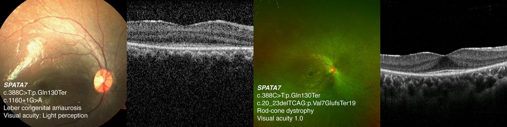 - 검안및콘택트렌즈학회지 2018 년제 17 권제 4 호 - A B C D Figure 1. Leber congenital amaurosis and rod-cone dystrophy phenotypes according to different SPATA7 mutations.