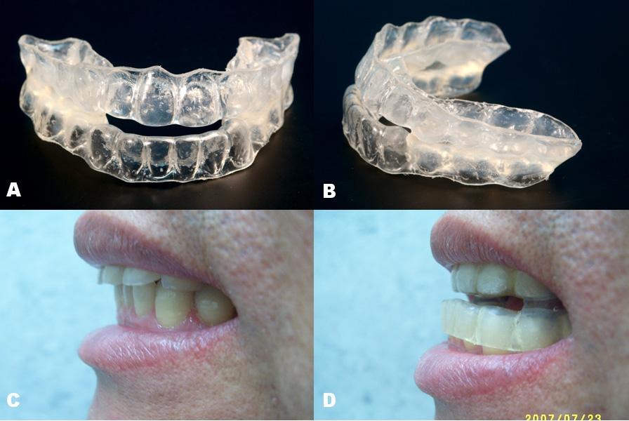While soft, the appliance is fitted to a patient s upper and lower jaws and then is cooled to be ready for use at night. Figure 2.