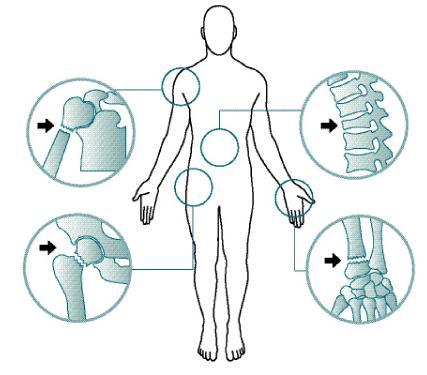 Manifestations - Adults Bone discomfort or pain in low back, pelvis,