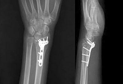 3. mm 수장측잠김압박금속판과 2.4 mm 수장측잠김압박금속판 161 Fig. 3. (A) 64 year old male patient presented with distal radius fracture as AO classification C2. (B) radiographs show volar fixation using 2.