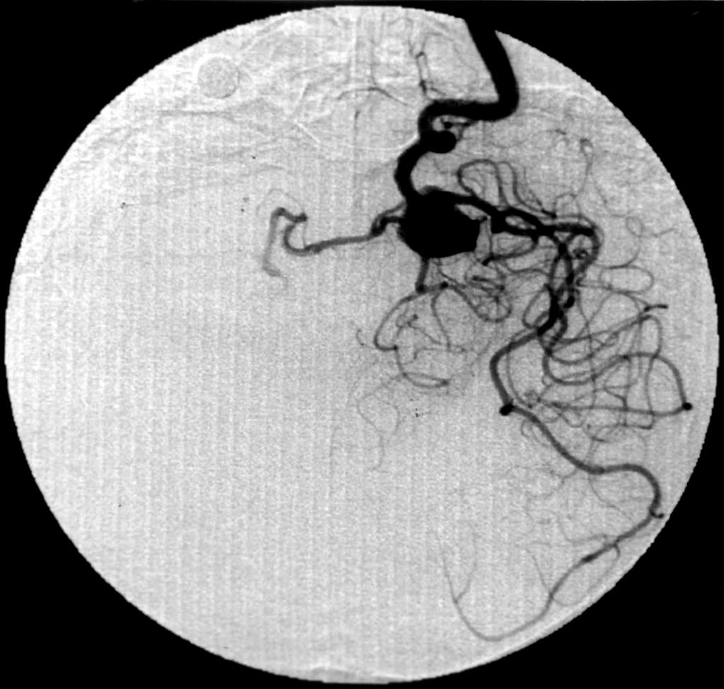 코일을 이용한 뇌동맥류의 혈관내 치료 효용성과 한계점 Fig. 2. Case 10. Left A Large unruptured ICA bifurcation artery aneurysm is shown on the left ICA angiogram. Right The aneurysm is occluded completely with GDC coils.
