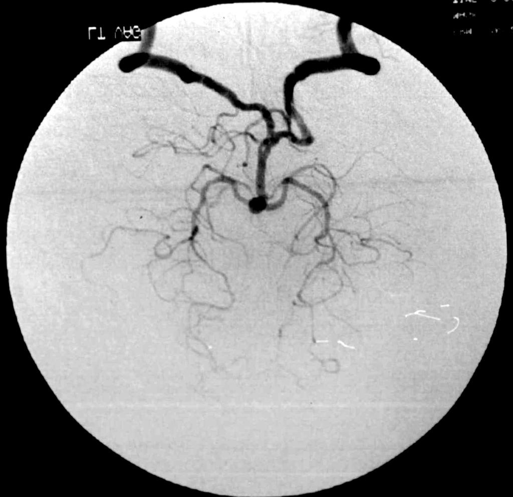 김종수 변홍식 김기준 이정일 홍승철 신형진 박 관 어 환 김종현 Fig. 3. Case 8. Left On vertebral angiogram, a small basilar bifurcation artery aneurysm is shown.
