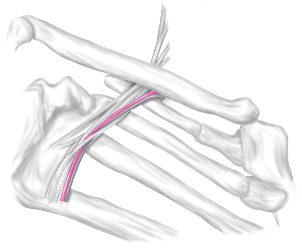 제 01 장 흉곽출구증후군 2) 늑쇄간격 : 2번째터널사각근간을통과한과쇄골하동맥을이어서기다리는터널이늑쇄간격이다. 이터널은윗면이쇄골 ( 쇄골하근 ), 바닥면이제1늑골로구성된 골성터널 이다 ( 그림 1-3). 또사각근간을통과하지않는쇄골하정맥도늑쇄간격은지난다. 어깨가처진자세로쇄골이내려가는상태에서는터널의윗면이낮아져과쇄골하동ㆍ정맥은압박된다 ( 그림 1-4).