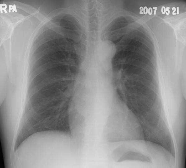 After one and half month, dyspnea and cough were developed. A. Chest PA shows diffuse increased haziness in both lower lung zone. B.