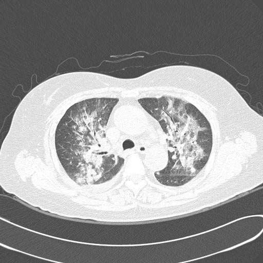 1), 폐쇄성세기관지기질화폐렴 (bronchiolitis obliterans organizing pneumonia) 이 2명 (Fig.