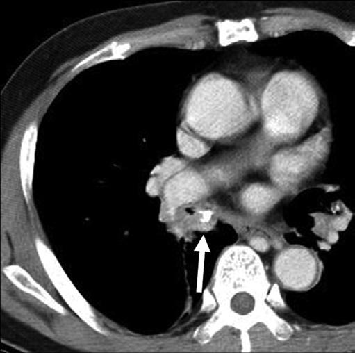 mass-like opacity obscuring the diaphragmatic border in the right lower lung field