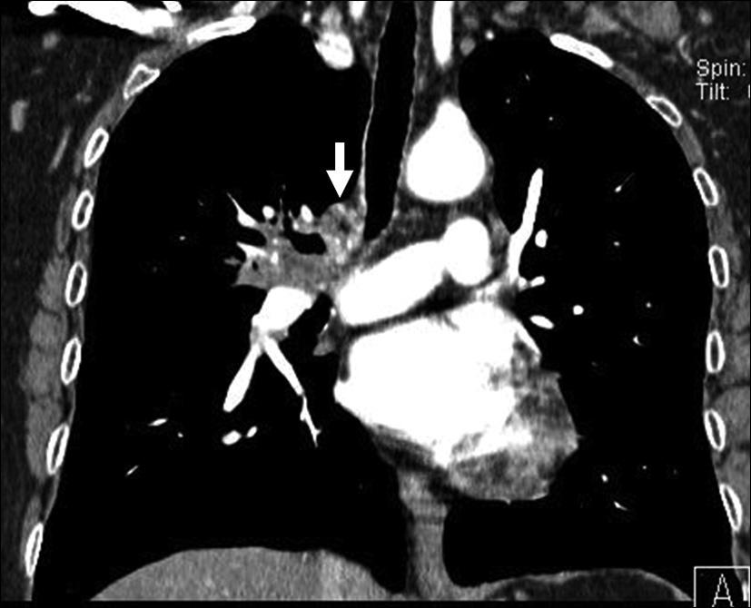 Lateral chest radiograph in a 68-year-old man shows atelectasis and consolidation in